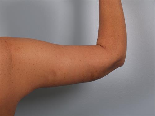 Brachioplasty (Arm Lift) After Photo | Phoenix and Scottsdale, AZ | Scottsdale Center for Plastic Surgery