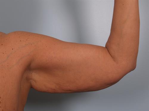 Brachioplasty (Arm Lift) Before Photo | Phoenix and Scottsdale, AZ | Scottsdale Center for Plastic Surgery