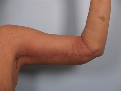Brachioplasty (Arm Lift) After Photo | Phoenix and Scottsdale, AZ | Scottsdale Center for Plastic Surgery