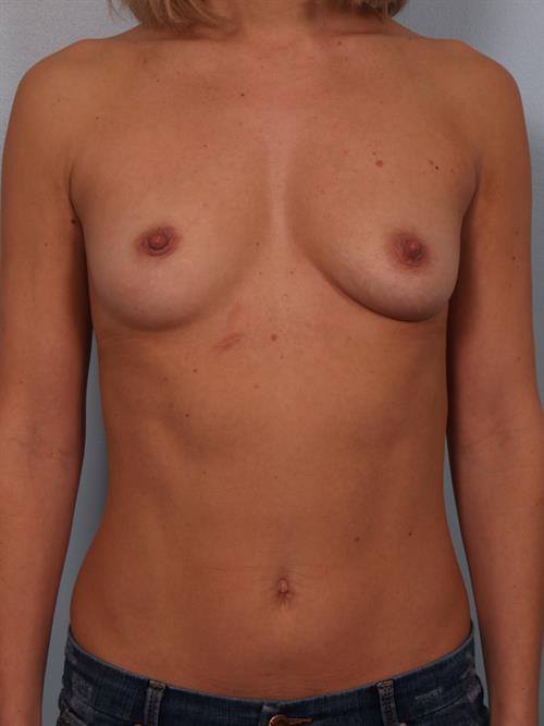 Breast Augmentation Before Photo | Phoenix and Scottsdale, AZ | Scottsdale Center for Plastic Surgery