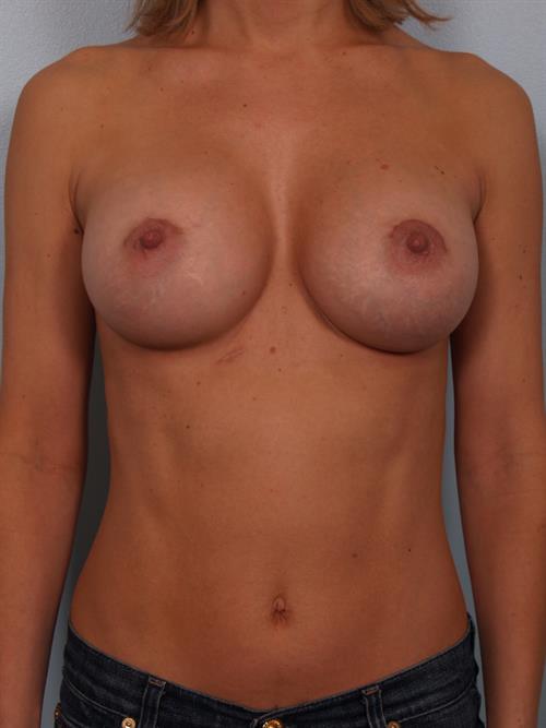 Breast Augmentation After Photo | Phoenix and Scottsdale, AZ | Scottsdale Center for Plastic Surgery