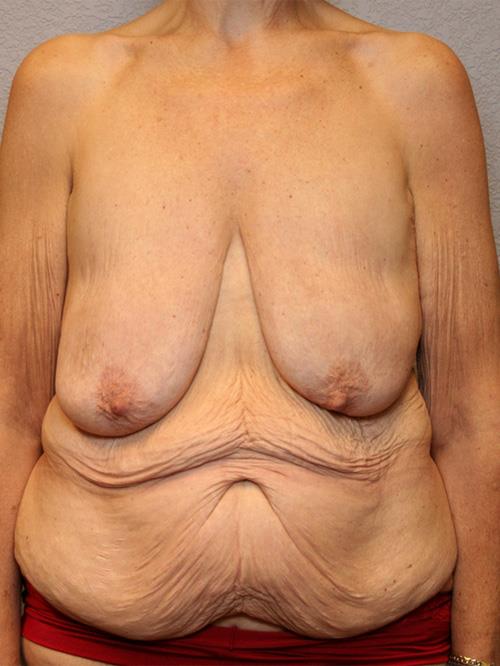 Breast Lift (Mastopexy) Before Photo | Phoenix and Scottsdale, AZ | Scottsdale Center for Plastic Surgery