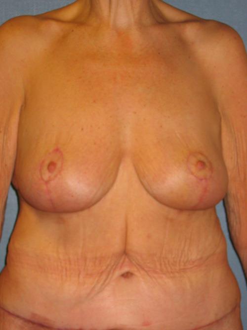 Breast Lift (Mastopexy) After Photo | Phoenix and Scottsdale, AZ | Scottsdale Center for Plastic Surgery
