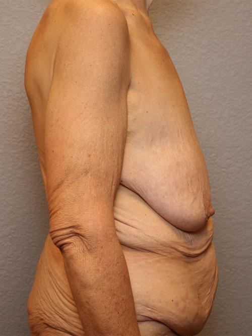 Breast Lift (Mastopexy) Before Photo | Phoenix and Scottsdale, AZ | Scottsdale Center for Plastic Surgery