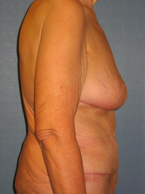 Breast Lift (Mastopexy) After Photo | Phoenix and Scottsdale, AZ | Scottsdale Center for Plastic Surgery
