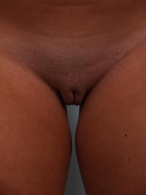 Labia Reduction After Photo | Phoenix and Scottsdale, AZ | Scottsdale Center for Plastic Surgery