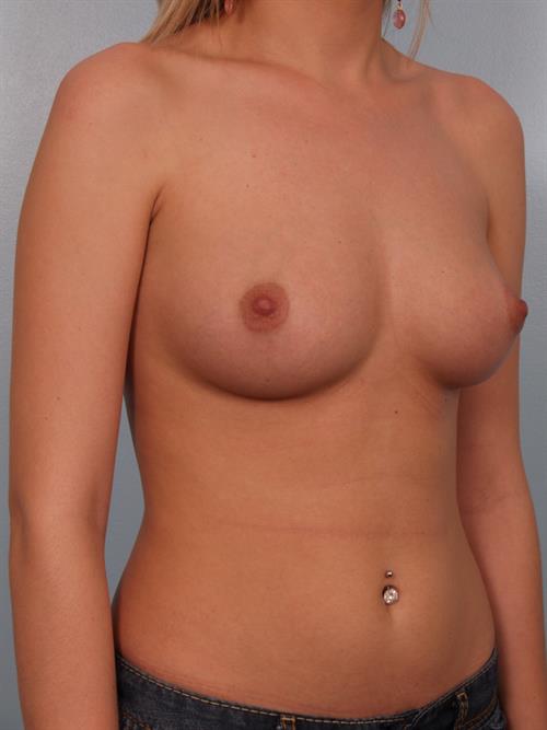 Breast Augmentation Before Photo | Phoenix and Scottsdale, AZ | Scottsdale Center for Plastic Surgery