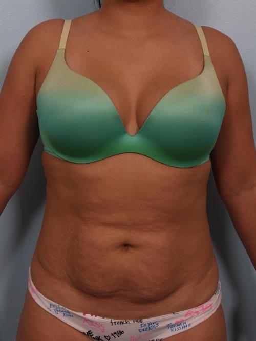 Power Assisted Liposuction Before Photo | Phoenix and Scottsdale, AZ | Scottsdale Center for Plastic Surgery