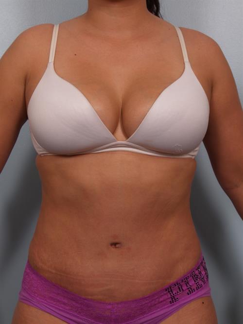 Power Assisted Liposuction After Photo | Phoenix and Scottsdale, AZ | Scottsdale Center for Plastic Surgery