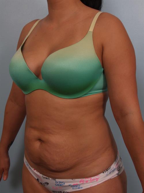 Power Assisted Liposuction Before Photo | Phoenix and Scottsdale, AZ | Scottsdale Center for Plastic Surgery