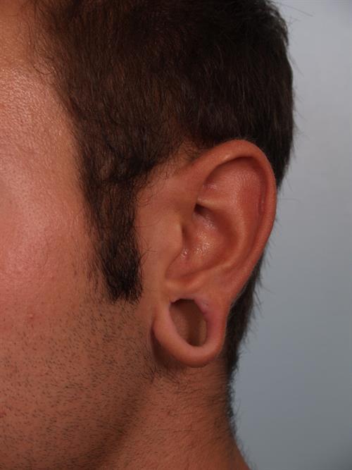 Otoplasty (Ear Reshaping) Before Photo | Phoenix and Scottsdale, AZ | Scottsdale Center for Plastic Surgery