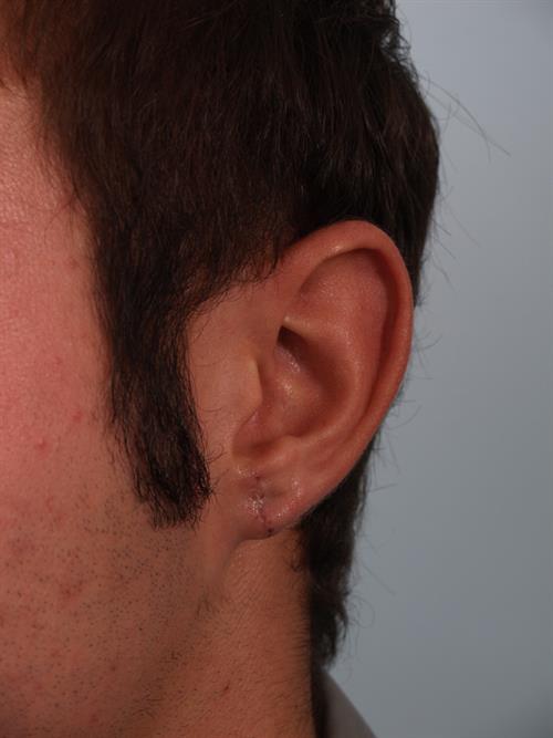 Otoplasty (Ear Reshaping) After Photo | Phoenix and Scottsdale, AZ | Scottsdale Center for Plastic Surgery