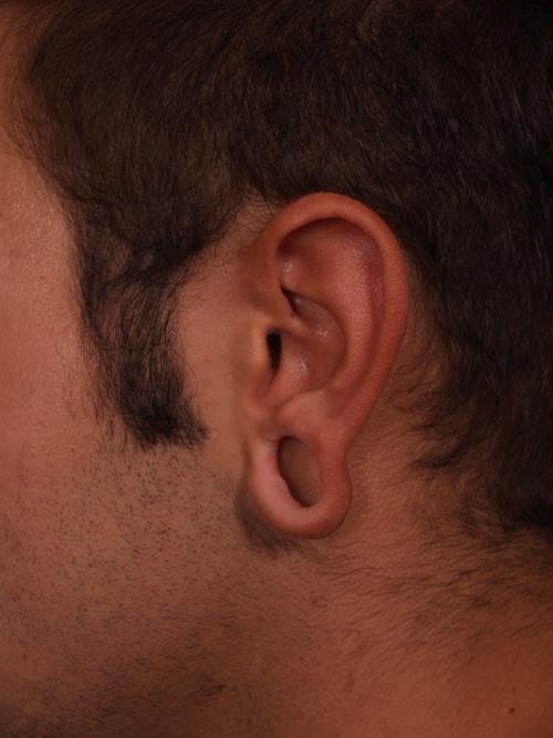 Otoplasty (Ear Reshaping) Before Photo | Phoenix and Scottsdale, AZ | Scottsdale Center for Plastic Surgery