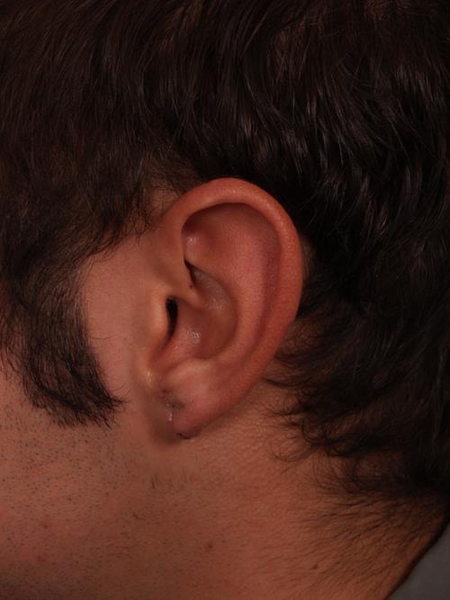 Otoplasty (Ear Reshaping) After Photo | Phoenix and Scottsdale, AZ | Scottsdale Center for Plastic Surgery