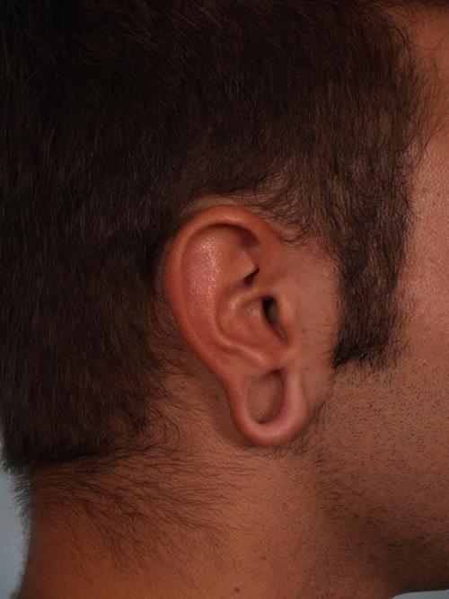 Otoplasty (Ear Reshaping) Before Photo | Phoenix and Scottsdale, AZ | Scottsdale Center for Plastic Surgery