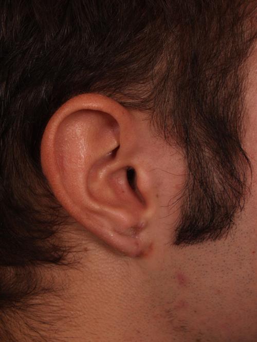 Otoplasty (Ear Reshaping) After Photo | Phoenix and Scottsdale, AZ | Scottsdale Center for Plastic Surgery