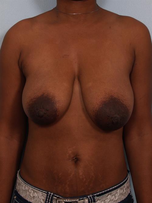 Breast Reduction Before Photo | Phoenix and Scottsdale, AZ | Scottsdale Center for Plastic Surgery
