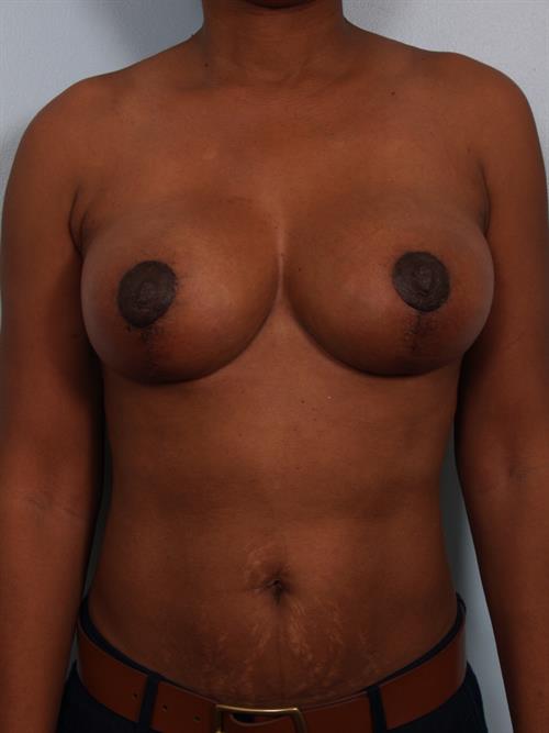 Breast Reduction After Photo | Phoenix and Scottsdale, AZ | Scottsdale Center for Plastic Surgery