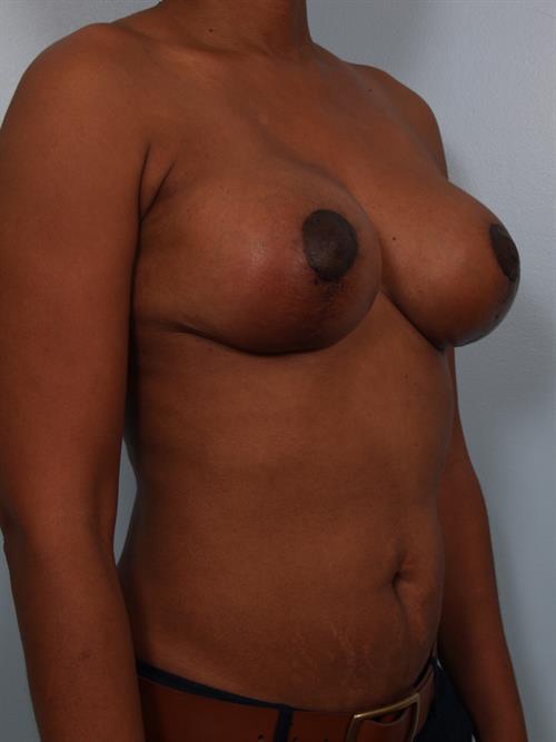 Breast Reduction After Photo | Phoenix and Scottsdale, AZ | Scottsdale Center for Plastic Surgery