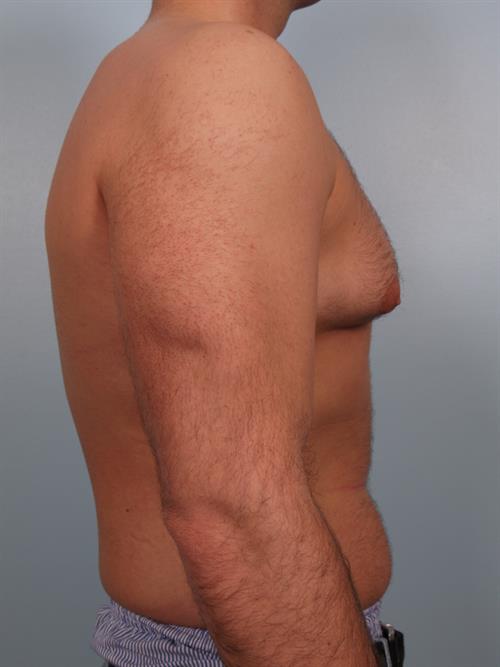 Male Breast/Areola Reduction Before Photo | Phoenix and Scottsdale, AZ | Scottsdale Center for Plastic Surgery