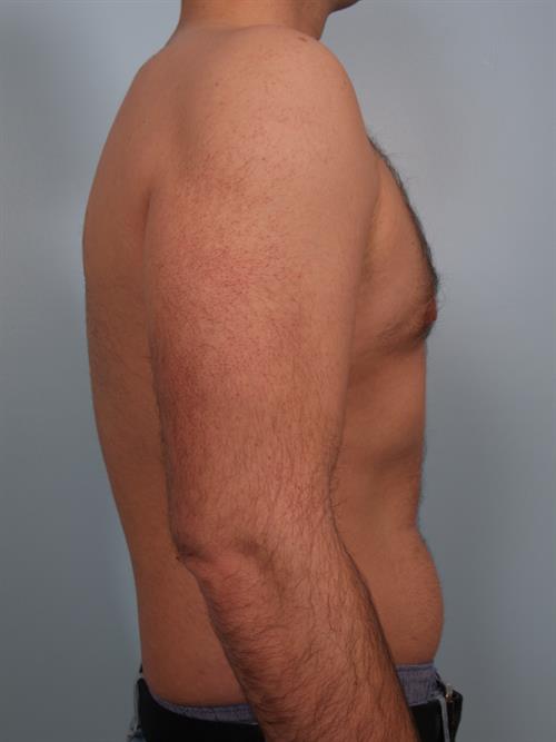 Male Breast/Areola Reduction After Photo | Phoenix and Scottsdale, AZ | Scottsdale Center for Plastic Surgery