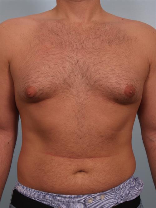 Male Breast/Areola Reduction Before Photo | Phoenix and Scottsdale, AZ | Scottsdale Center for Plastic Surgery