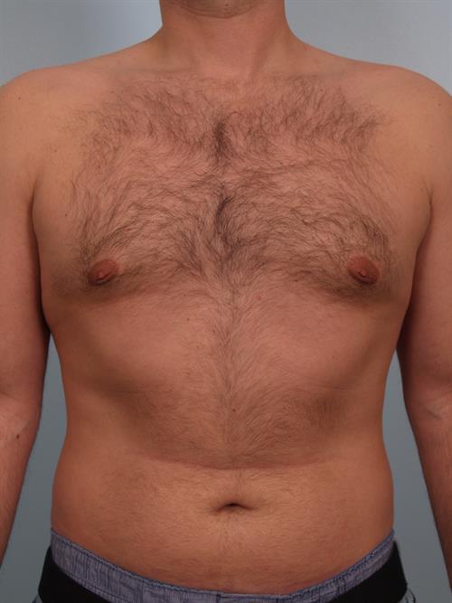 Male Breast/Areola Reduction After Photo | Phoenix and Scottsdale, AZ | Scottsdale Center for Plastic Surgery