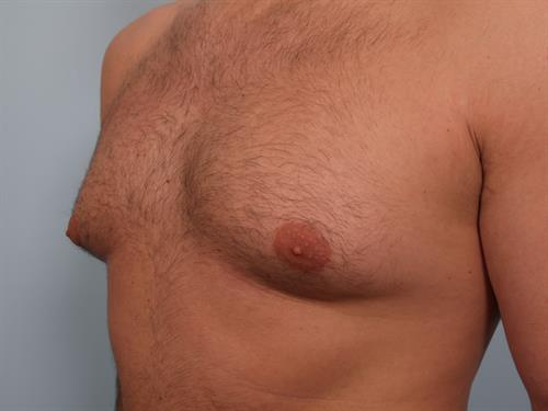 Male Breast/Areola Reduction Before Photo | Phoenix and Scottsdale, AZ | Scottsdale Center for Plastic Surgery