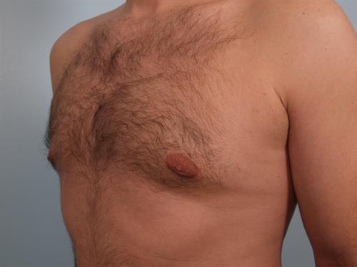 Male Breast/Areola Reduction After Photo | Phoenix and Scottsdale, AZ | Scottsdale Center for Plastic Surgery
