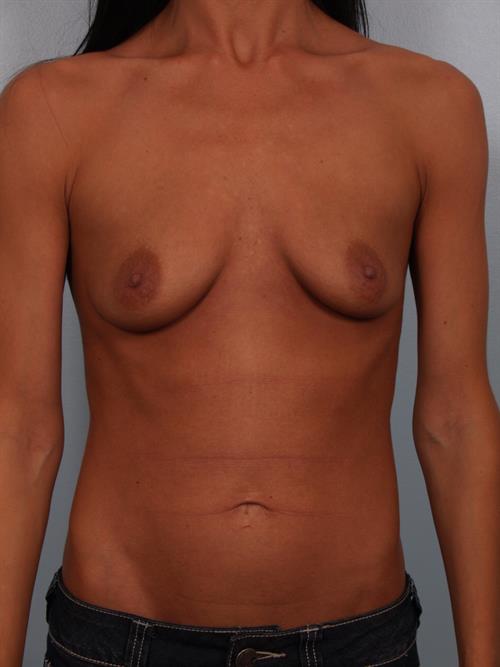 Breast Augmentation Before Photo | Phoenix and Scottsdale, AZ | Scottsdale Center for Plastic Surgery