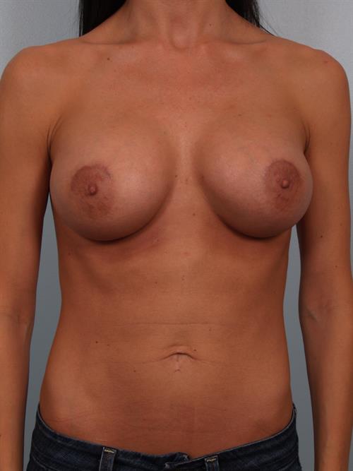 Breast Augmentation After Photo | Phoenix and Scottsdale, AZ | Scottsdale Center for Plastic Surgery