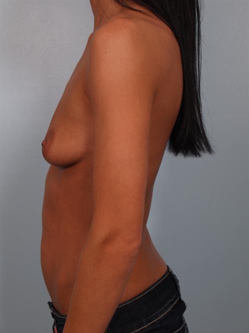 Breast Augmentation Before Photo | Phoenix and Scottsdale, AZ | Scottsdale Center for Plastic Surgery