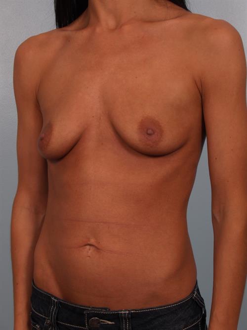 Breast Augmentation Before Photo | Phoenix and Scottsdale, AZ | Scottsdale Center for Plastic Surgery