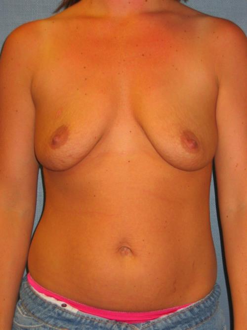 Breast Lift (Mastopexy) Before Photo | Phoenix and Scottsdale, AZ | Scottsdale Center for Plastic Surgery