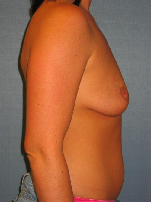 Breast Lift (Mastopexy) Before Photo | Phoenix and Scottsdale, AZ | Scottsdale Center for Plastic Surgery