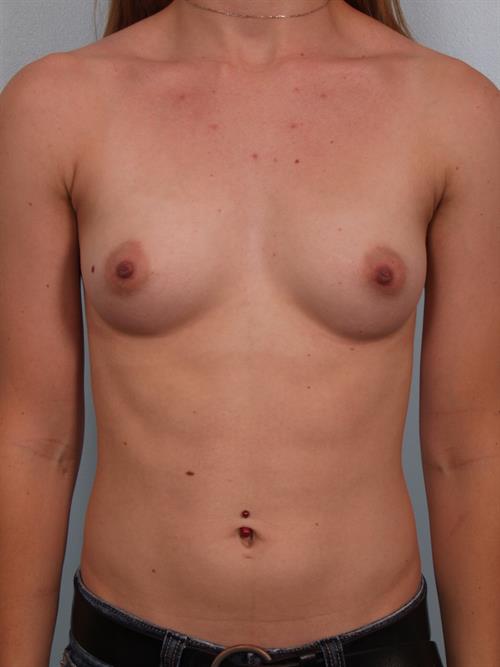 Breast Augmentation Before Photo | Phoenix and Scottsdale, AZ | Scottsdale Center for Plastic Surgery