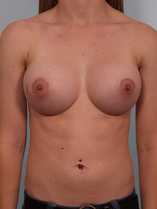 Breast Augmentation After Photo | Phoenix and Scottsdale, AZ | Scottsdale Center for Plastic Surgery