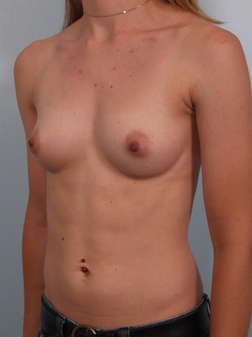 Breast Augmentation Before Photo | Phoenix and Scottsdale, AZ | Scottsdale Center for Plastic Surgery