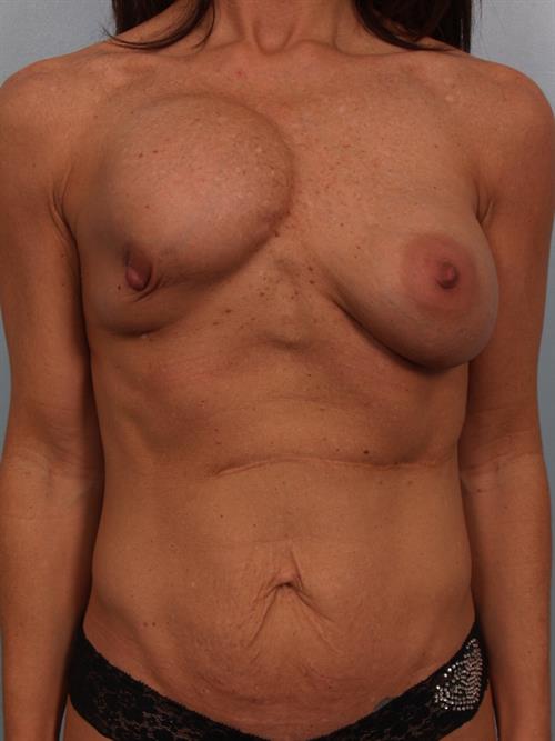 Revision Breast Surgery Before Photo | Phoenix and Scottsdale, AZ | Scottsdale Center for Plastic Surgery