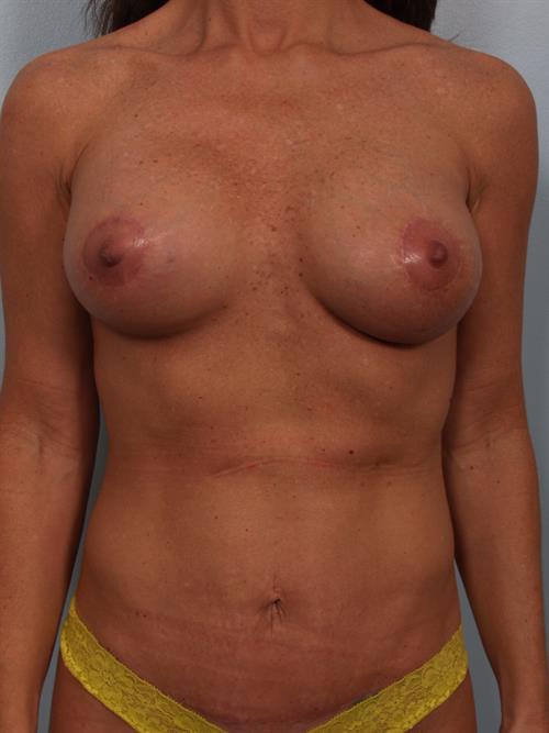 Revision Breast Surgery After Photo | Phoenix and Scottsdale, AZ | Scottsdale Center for Plastic Surgery