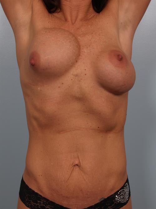 Revision Breast Surgery Before Photo | Phoenix and Scottsdale, AZ | Scottsdale Center for Plastic Surgery