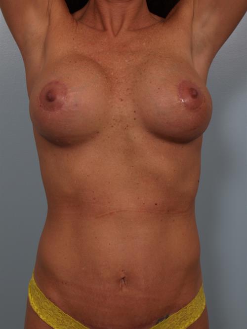 Revision Breast Surgery After Photo | Phoenix and Scottsdale, AZ | Scottsdale Center for Plastic Surgery