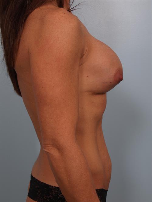 Revision Breast Surgery Before Photo | Phoenix and Scottsdale, AZ | Scottsdale Center for Plastic Surgery