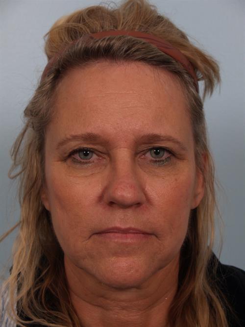 Eyelid Surgery Before Photo | Phoenix and Scottsdale, AZ | Scottsdale Center for Plastic Surgery