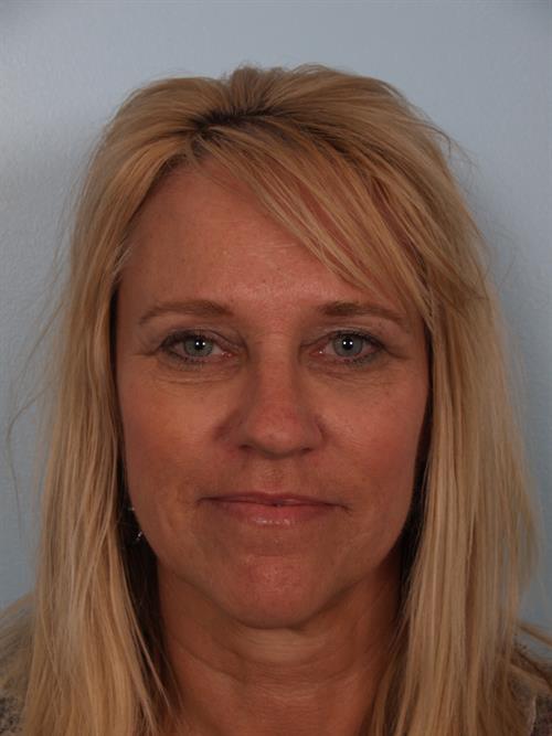 Eyelid Surgery After Photo | Phoenix and Scottsdale, AZ | Scottsdale Center for Plastic Surgery
