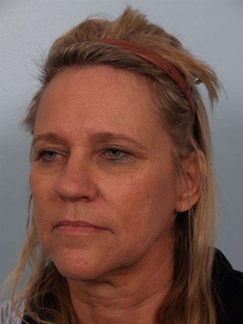 Eyelid Surgery Before Photo | Phoenix and Scottsdale, AZ | Scottsdale Center for Plastic Surgery