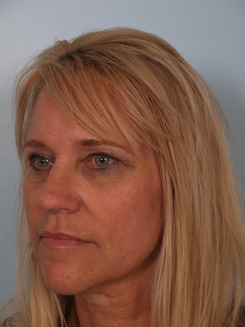 Eyelid Surgery After Photo | Phoenix and Scottsdale, AZ | Scottsdale Center for Plastic Surgery