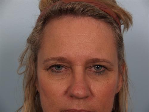 Eyelid Surgery Before Photo | Phoenix and Scottsdale, AZ | Scottsdale Center for Plastic Surgery