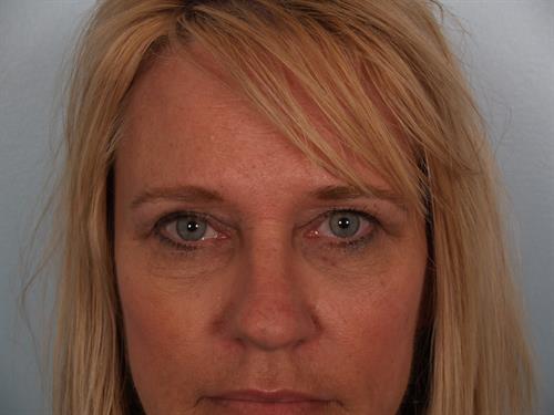Eyelid Surgery After Photo | Phoenix and Scottsdale, AZ | Scottsdale Center for Plastic Surgery