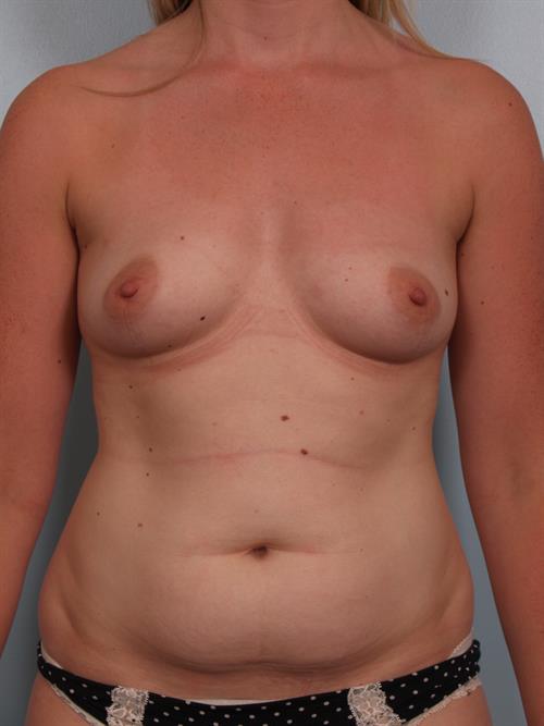 Breast Augmentation Before Photo | ,  | 